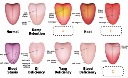 When you stick out your tongue, a TCM practitioner takes note of the following: The coating on top of the tongue, if there is a furriness to the coating, the color, size of the crack, bumps, and saliva levels. The tongue represents in TCM theory a map of the organs and meridian system. Fill the missing blanks with the corresponding diagnosis: